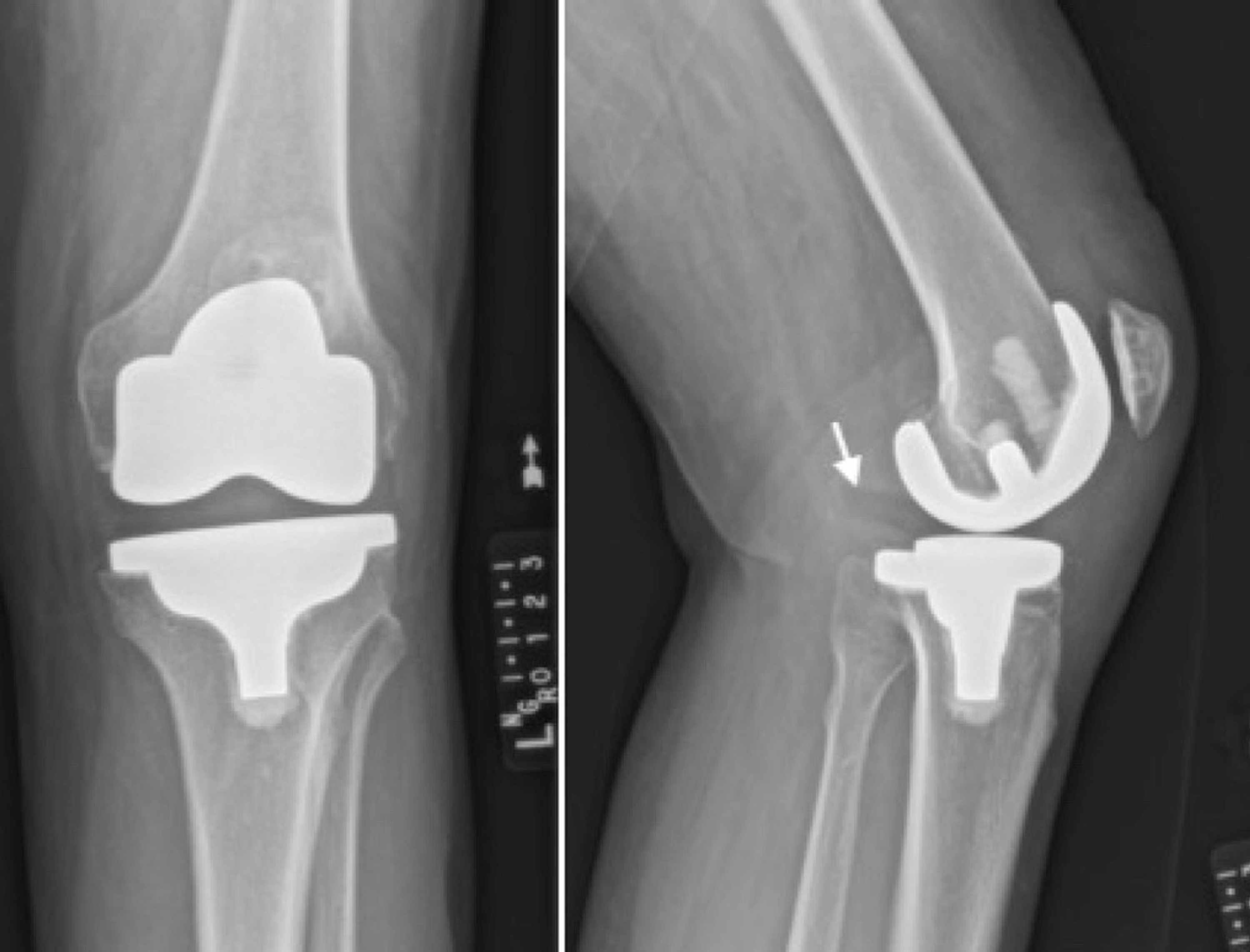 Cureus | Dissociation of a Medial Pivot Polyethylene in a Kinematically ...