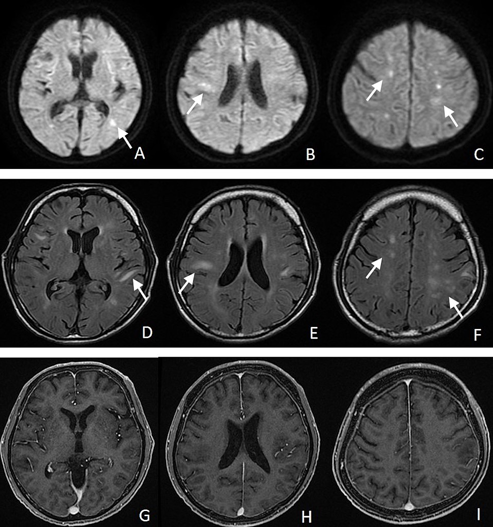 Cureus Intravascular Large B Cell Lymphoma Diagnosed By Open Brain Biopsy And Achievement Of 