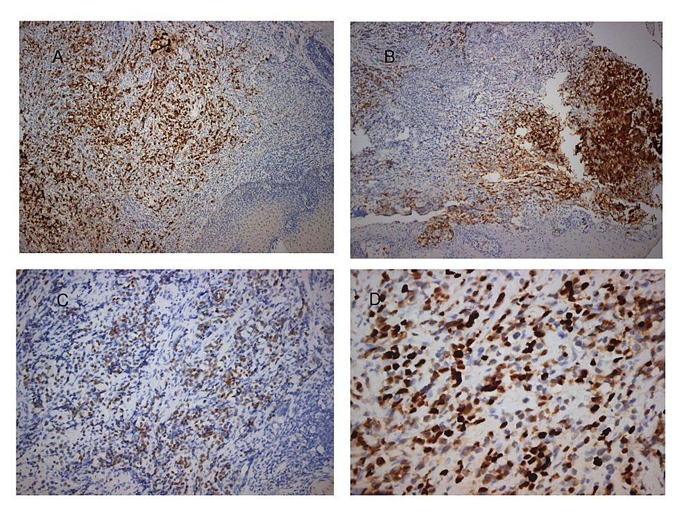 Cureus Large Cell Esophageal Neuroendocrine Carcinoma Report Of A Rare Case