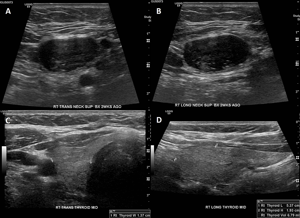 Ultrasound-of-right-neck-mass