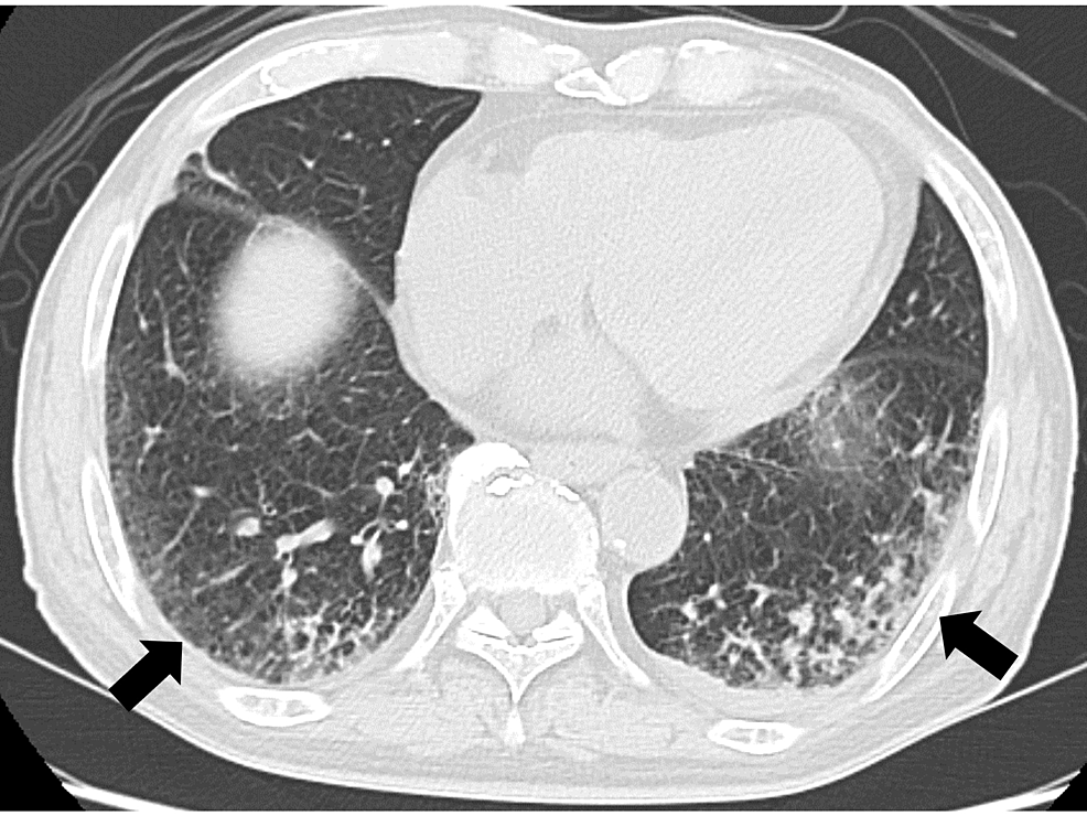 Chest-computed-tomography-image-showing-infiltration-in-the-bilateral-lower-lobes-of-the-lungs.