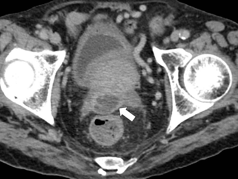 Pelvic-computed-tomography-image-showing-fluid-retention-in-the-posterior-part-of-the-prostate.