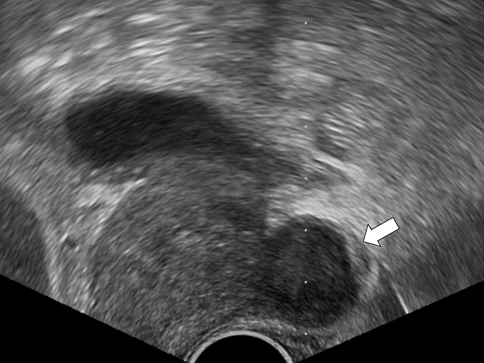Image-of-ultrasound-guided-fluid-aspiration-from-the-prostate.