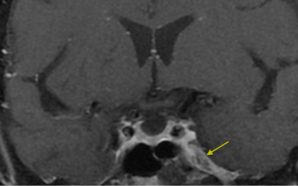 PDF] A review of the mandibular and maxillary nerve supplies and their  clinical relevance.