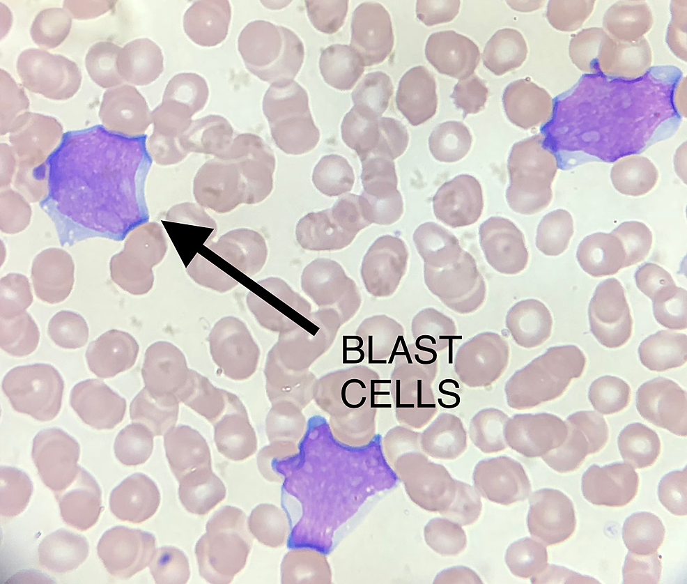 Hypercalcemia As The Sole Initial Presentation Of Precursor B-cell ...