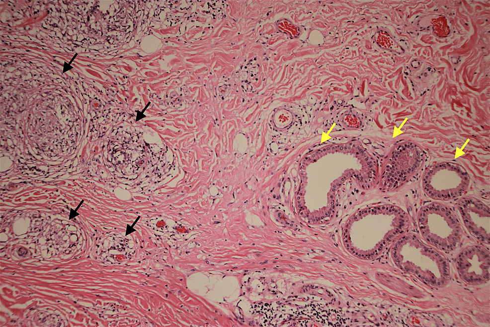 Histologic-section-showing non-necrotizing-granulomas
