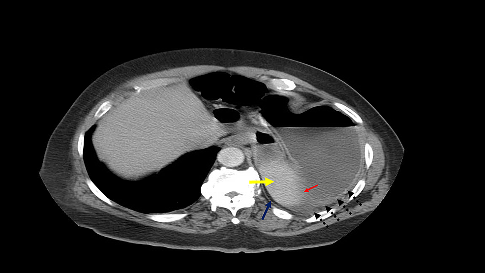 gastric volvulus: a rare entity case report and literature