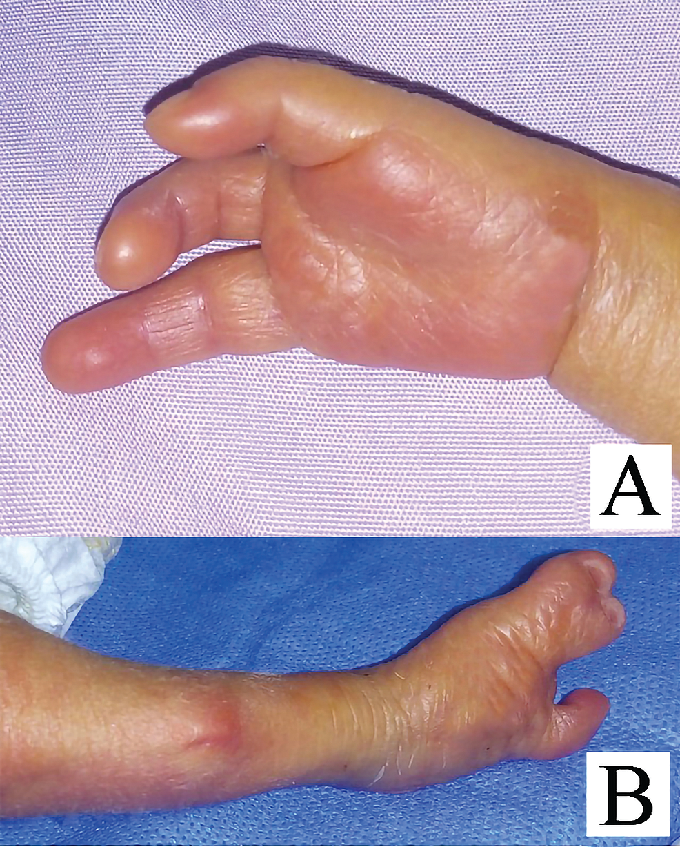 Unilateral Tibial Hemimelia with Leg Length Inequality and Varus Foot:  External Fixator Treatment - Andrés Carranza-Bencano, Ernesto  González-Rodríguez, 1999, image size:986x1227
