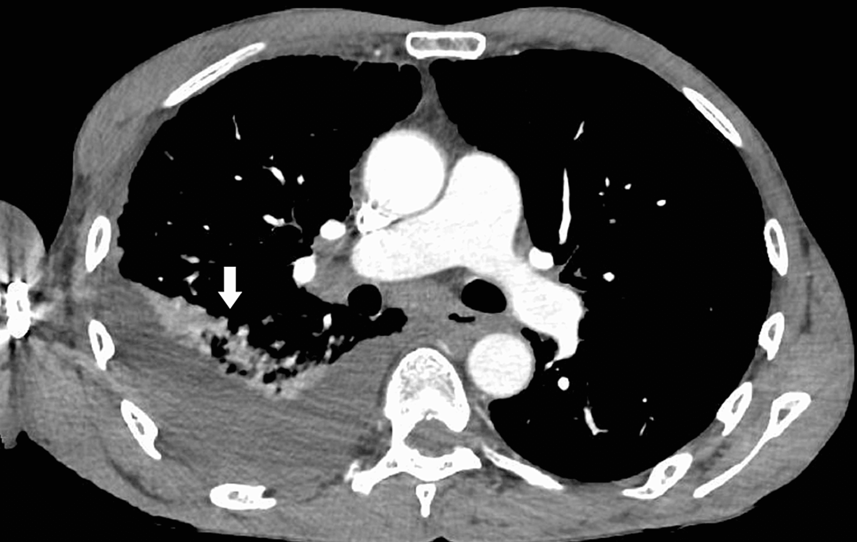 Cureus | Primary Effusion Lymphoma Presenting As Parapneumonic Pleural ...