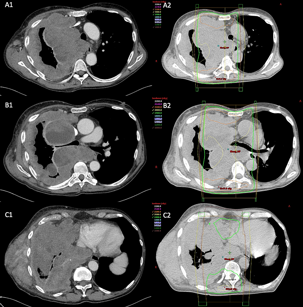 CT-Chest-prior-to-RT,-after-4-cycles-of-pembrolizumab.-Approximated-aerated-right-lung-is-15%.-A1)-Pleural-based-conglomerate-abutting-the-lateral-superior-mediastinum-measuring-up-to-85x152-mm.-B1)-Tumor-compression-of-right-mainstem-bronchus.-C1)-Lateral-chest-wall-mass,-between-right-lateral-latissimus-dorsi,-and-lateral-intercostal/rib-measures-75x146-mm.-Infiltrative-tumor-involving-inferior-aspect-of-right-lung.-A2,-B2,-and-C3-are-corresponding-RT-plan-illustrating-extent-of-disease-outside-of-the-field.-