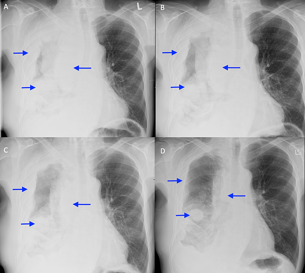 Chest-x-rays-after-RT-completed-illustrating-disease-response.-A)-Radiograph-taken-on-last-day-of-RT.-B)-3-weeks-after-RT-completed.-C)-9-weeks-after-RT-completed.-D)-14-weeks-after-RT-completed.--