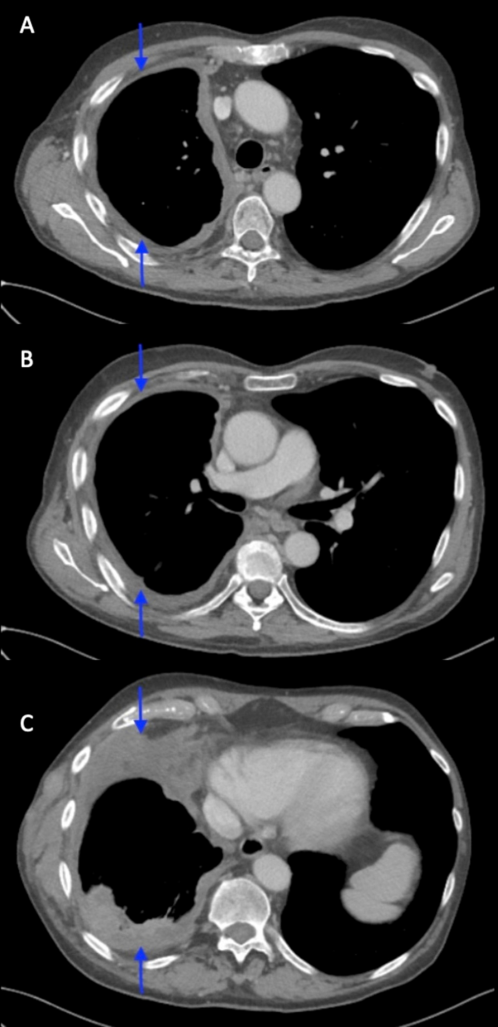 CT-Chest-5-months-after-completion-of-RT,-after-12-cycles-of-pembrolizumab.-Approximated-aerated-right-lung-is-90%.-A)-Right-pleural-based-confluent-mass-has-substantially-improved-to-12x1mm-along-the-lateral-superior-mediastinum.-B)-Compression-of-right-mainstem-bronchus-resolved.-C)-Lateral-chest-wall-mass-decreased-to-23x80mm.-Reduction-in-extent-of-tumor-mass.-