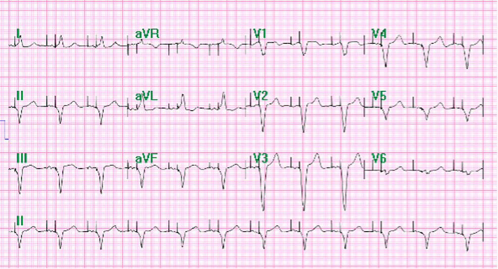 Cureus | Post-cardiac Injury Syndrome Following Permanent Dual-Chamber ...