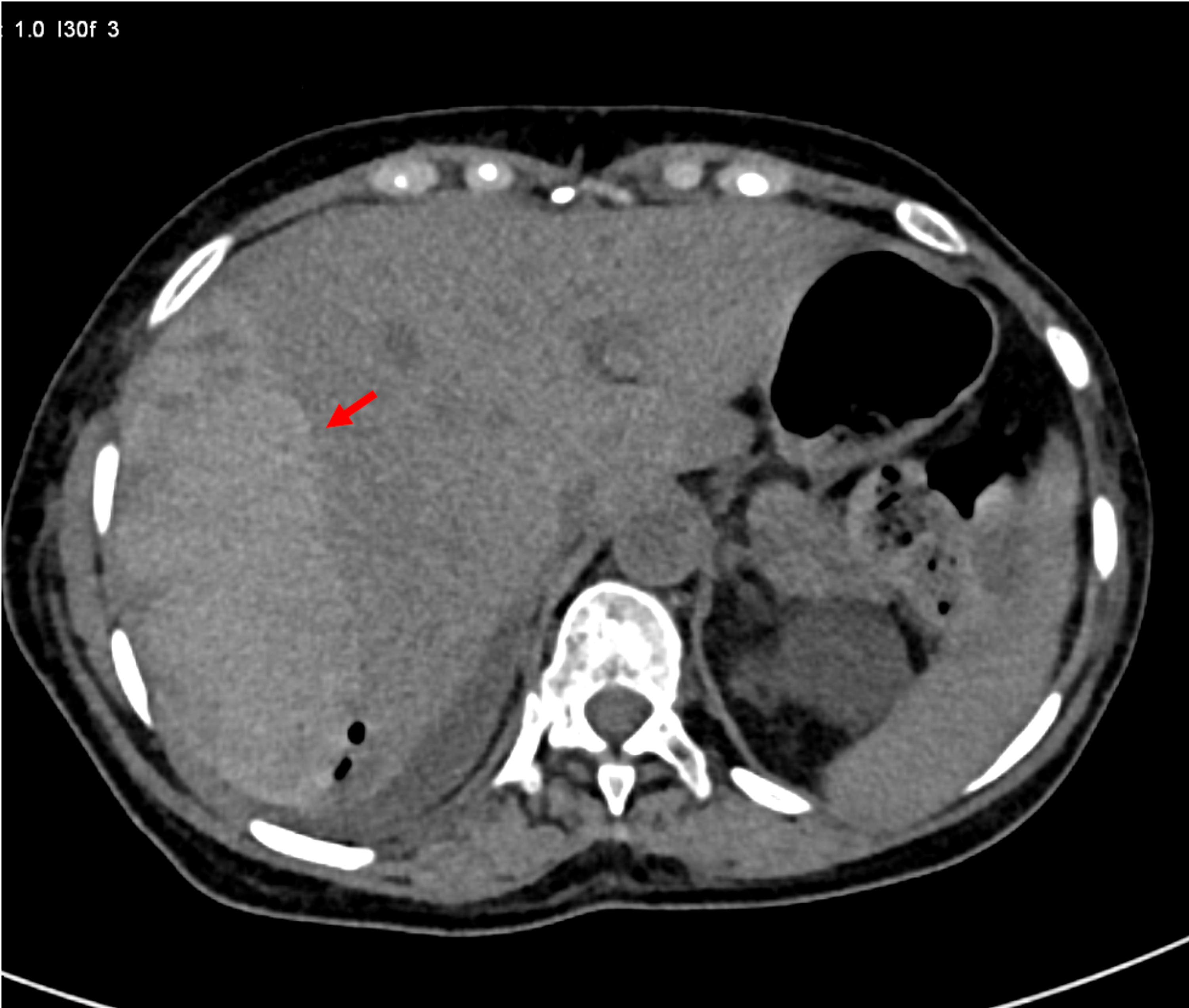 Cureus | Large Hepatic Subcapsular Hematoma Following Endoscopic ...