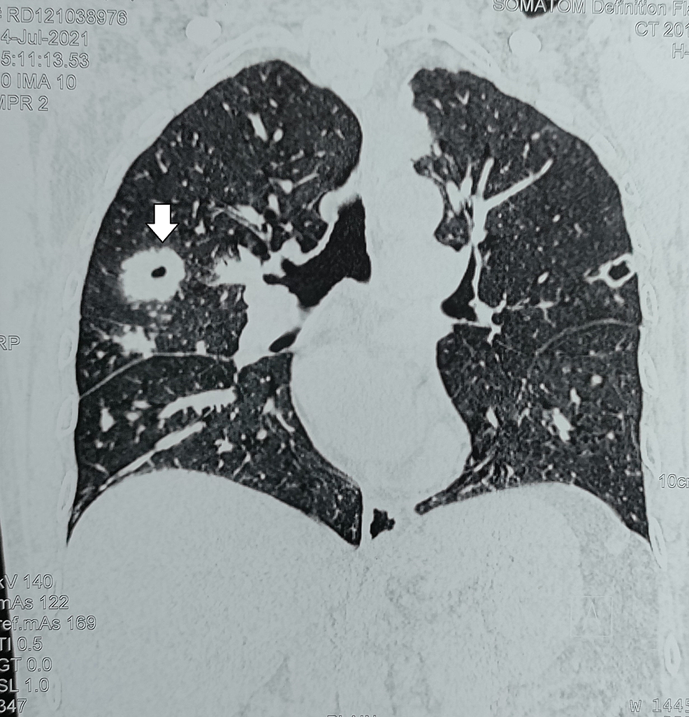 Coronal-CT-scan-of-the-chest-showing-a-large-cavitary-lesion-in-the-right-lung-(marked-by-an-arrow)