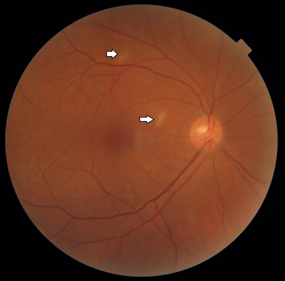 Fundus-photo-of-the-right-eye-with-areas-of-retinal-opacification,-as-shown-by-the-arrows