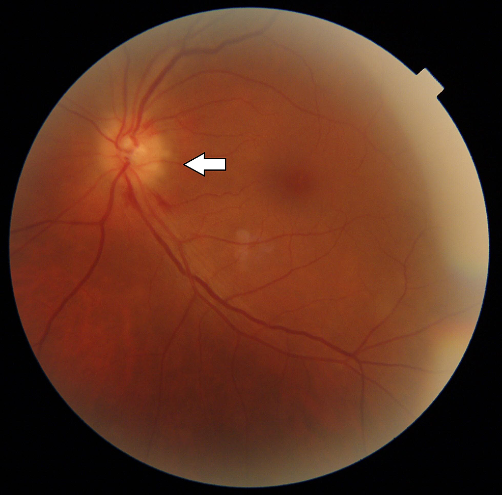 Fundus-photo-of-the-left-eye-showing-a-pale-edematous-optic-disc-(anterior-ischemic-optic-neuropathy,-AION)-(a-large-arrow-marks-the-optic-nerve-head)