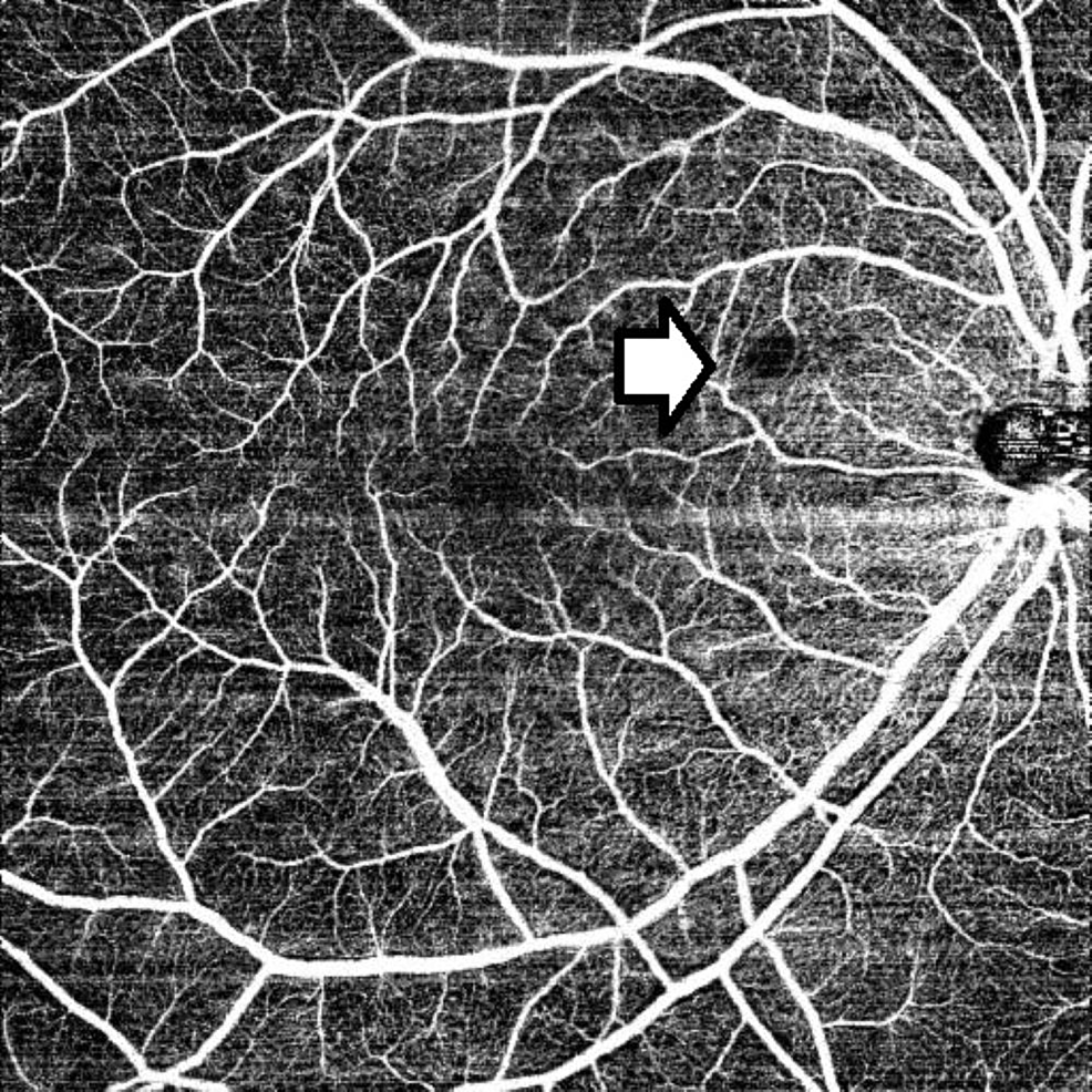 Pre-treatment-OCTA-of-the-superficial-capillary-plexus-with-an-area-of-capillary-drop-out-corresponding-to-the-retinal-opacification-(marked-by-a-white-arrow)