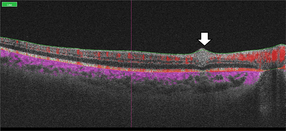 Structural-OCT-B-scan-passing-through-an-area-of-flow-void-demonstrating-uniform-hyperreflectivity-throughout-the-inner-retina,-as-marked-by-the-vertical-arrow.-