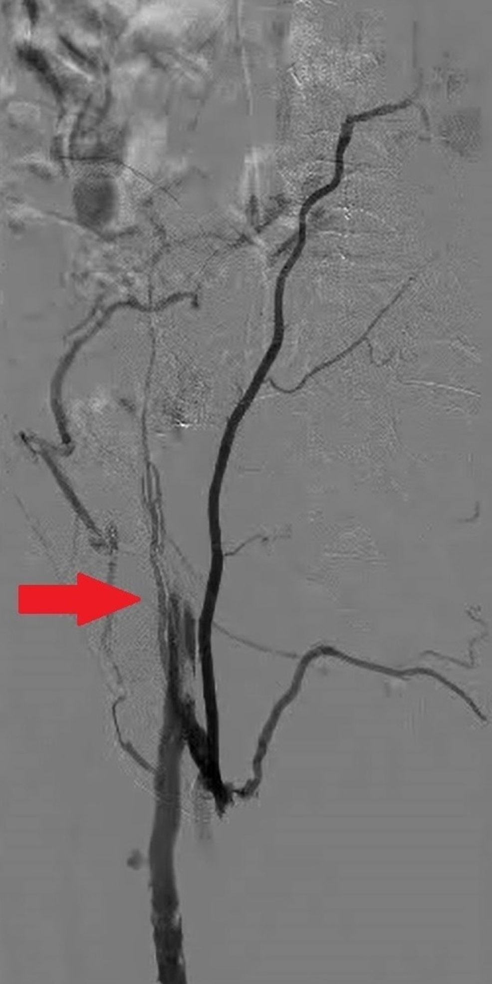 A-venogram-of-the-left-lower-extremity-with-abrupt-cessation-of-blood-flow-(red-arrow)-beyond-the-common-iliac-vein-with-extensive-collateral-formation