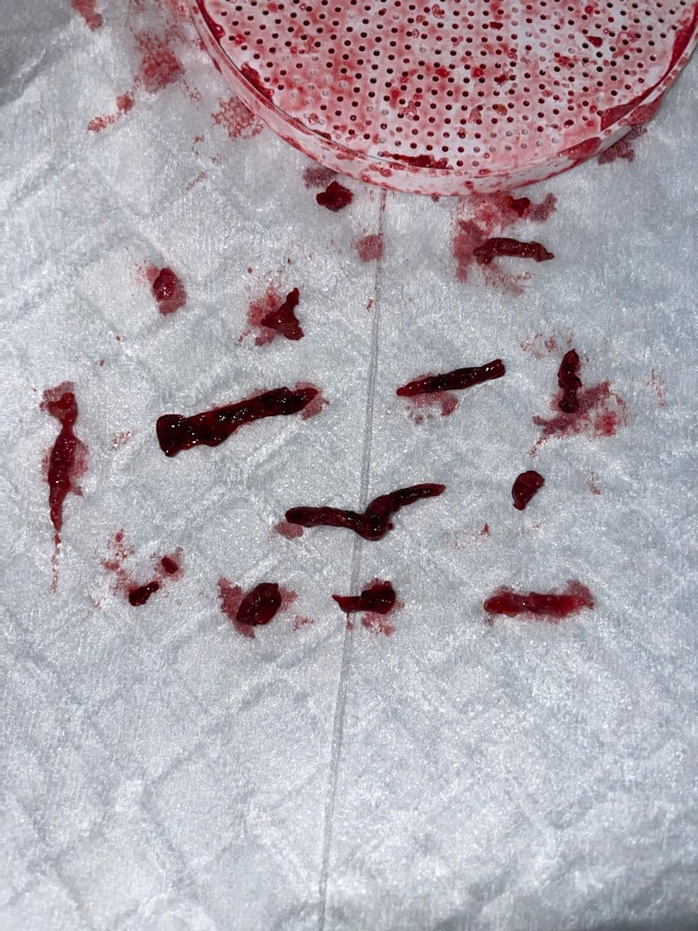 Clot-burden-removed-from-the-left-common-iliac-vein