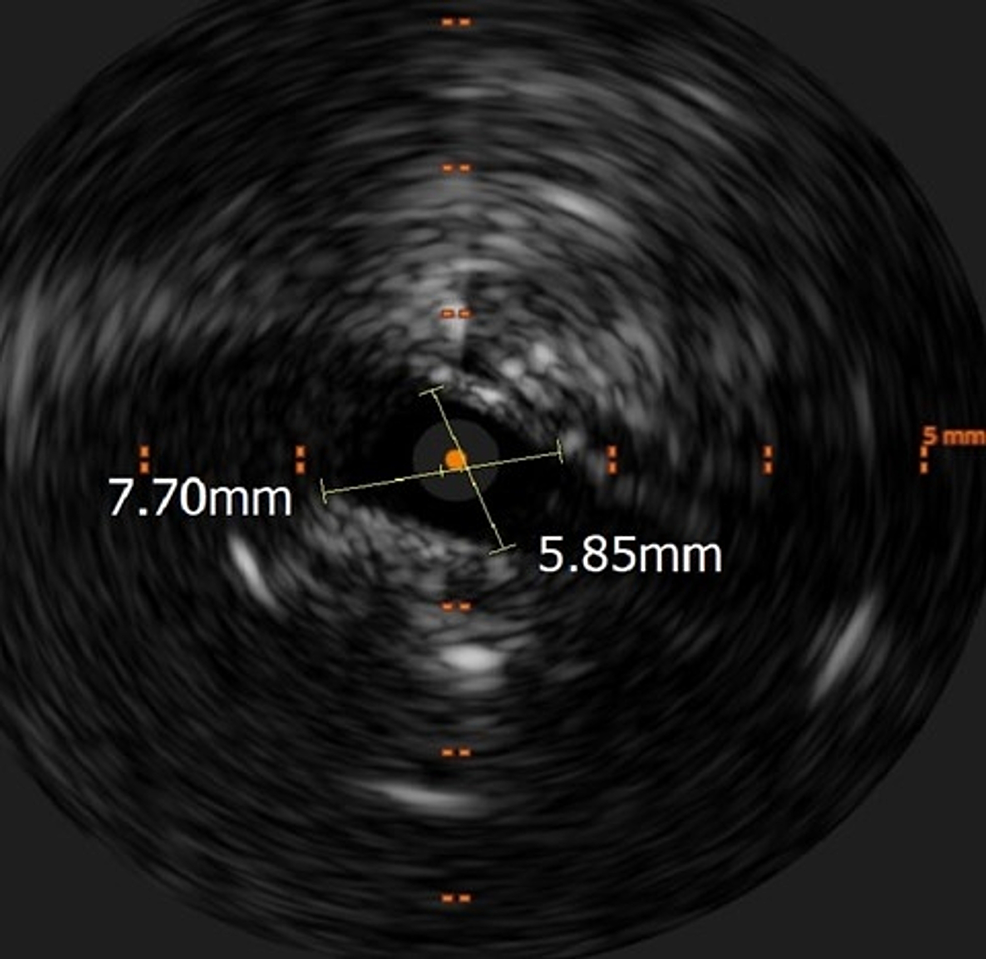Intravascular-ultrasound-showing-critical-luminal-narrowing