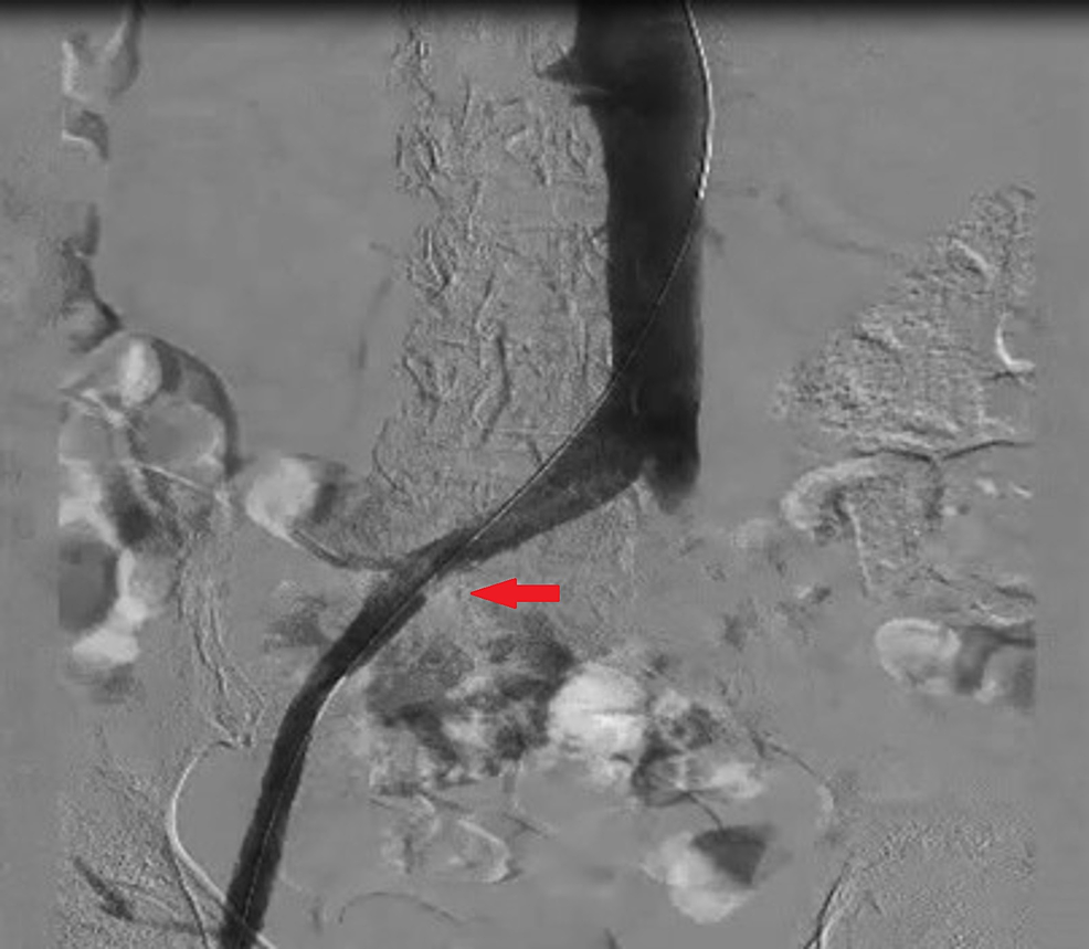 A-repeat-venogram-indicating-minimal-re-thrombosis-distal-to-the-common-iliac-vein-(red-arrow)