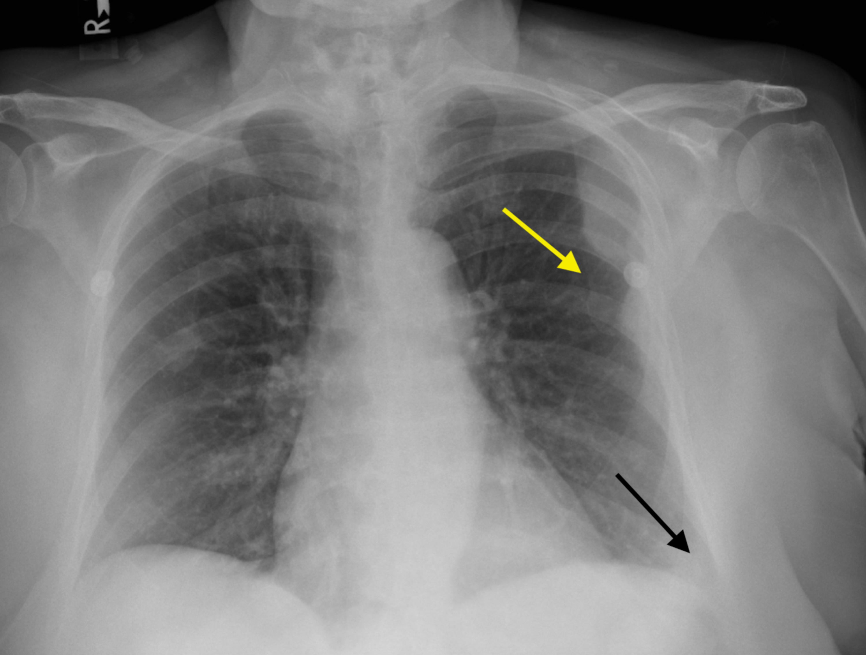 Diffuse Large Bcell Lymphoma Presenting as a Primary Pleural Mass A