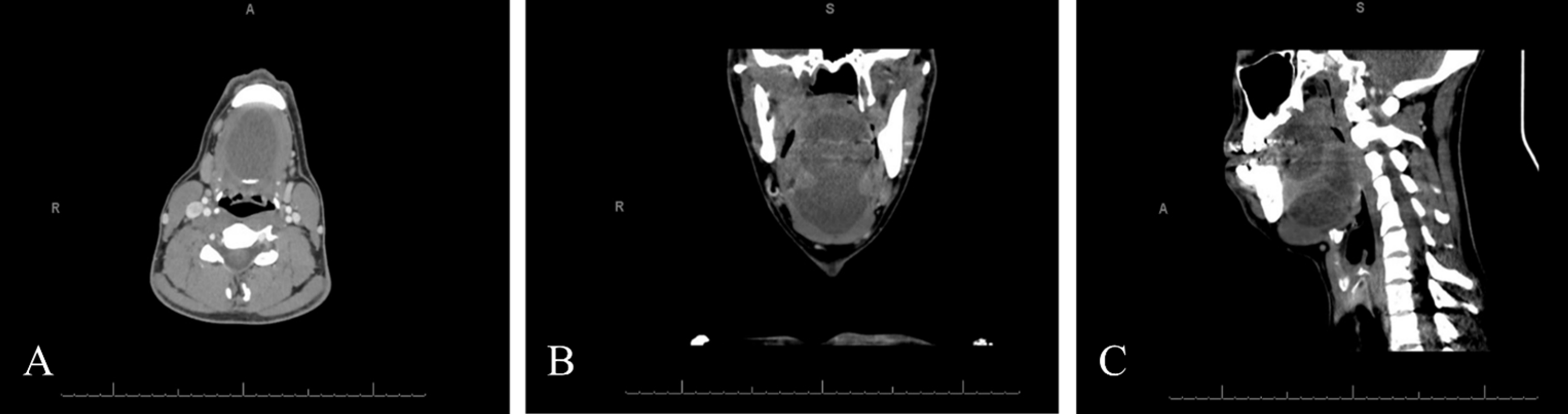 Floor Of Mouth Dermoid Cyst Radiology