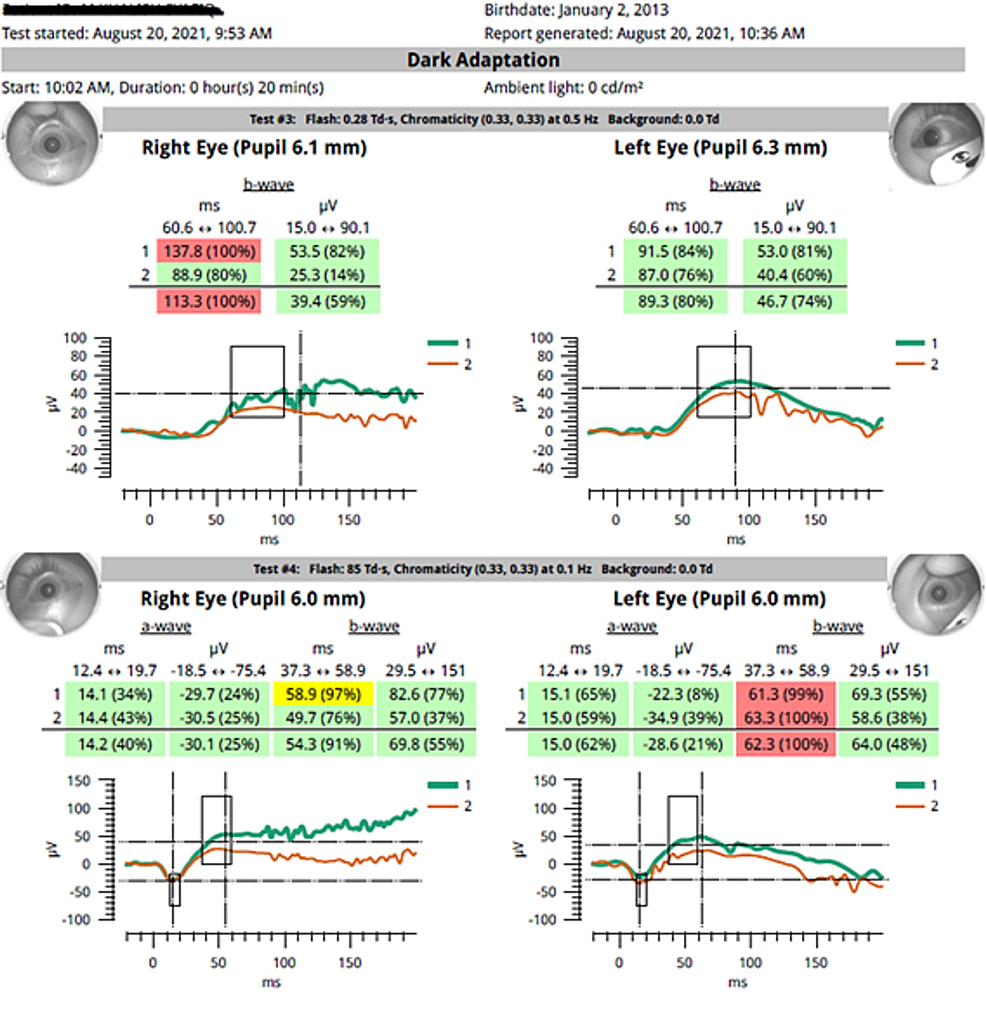 Cureus Optic Neuropathy in an Autistic Child With Vitamin A