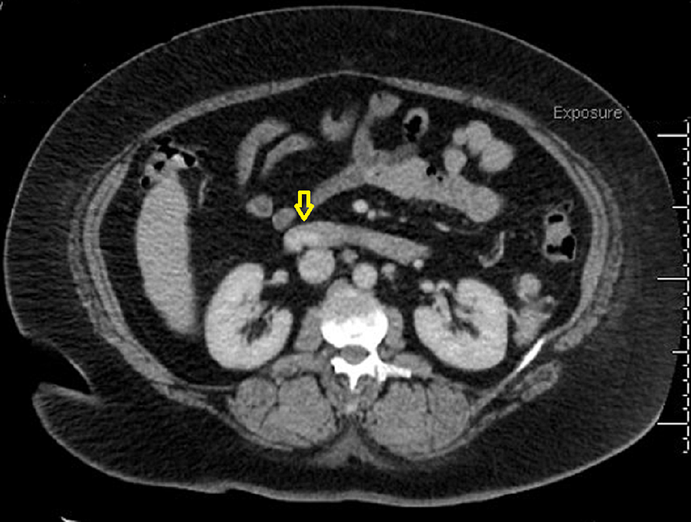 Endoscopic Band Ligation of Bleeding Duodenal Varices Cureus