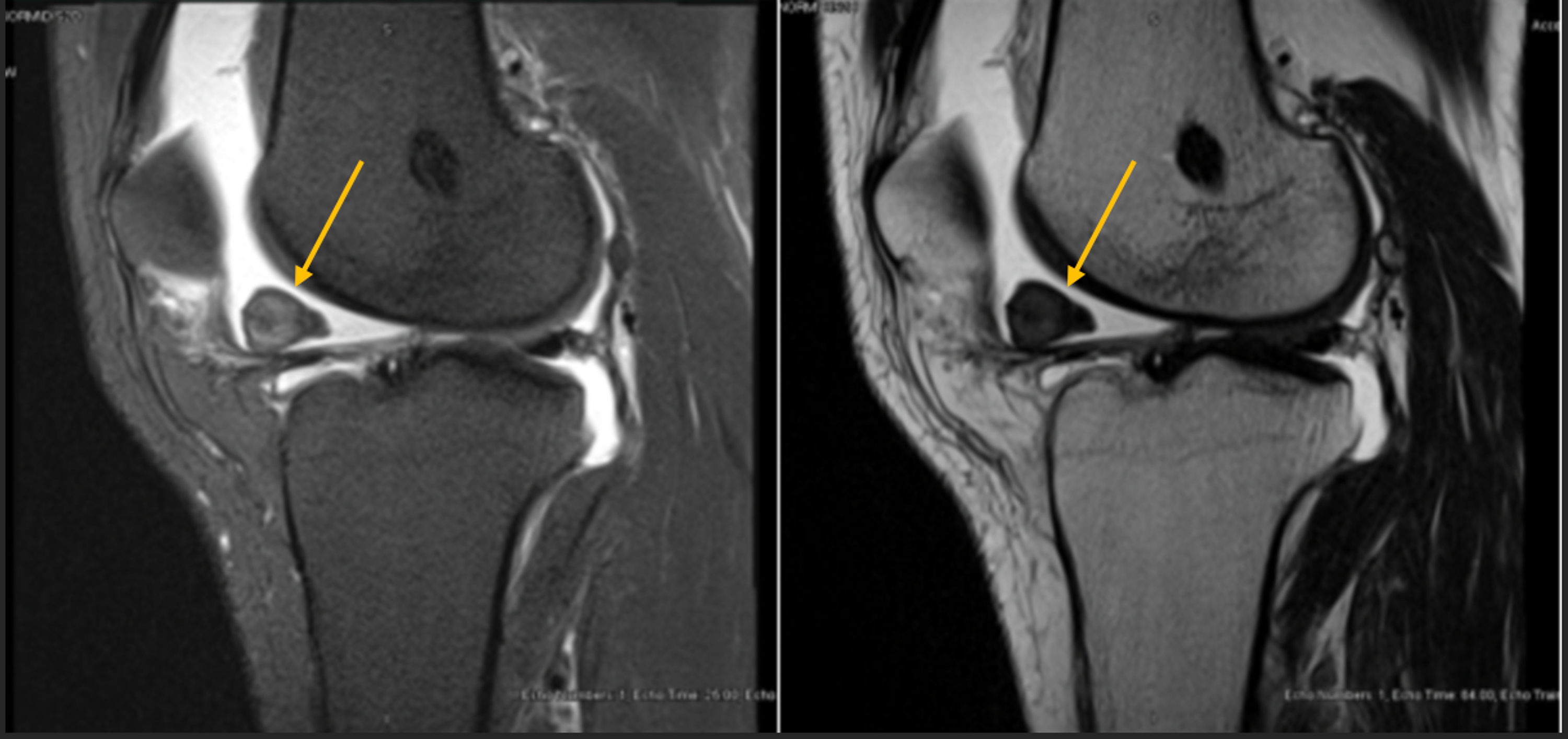 Cureus | Tenosynovial Giant Cell Tumor After ACL Reconstruction With ...