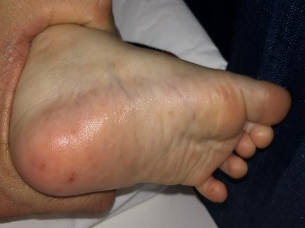 Purplish-macular-and-vesicular-lesions-on-the-soles-of-the-foot
