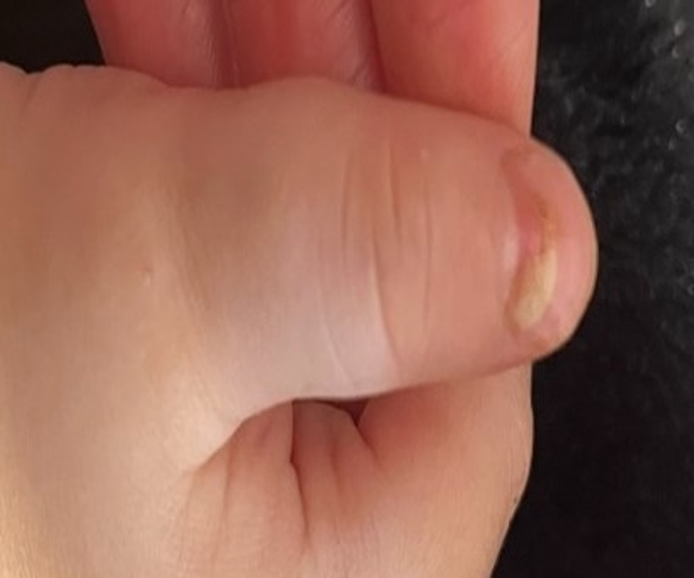 Onychomadesis-of-the-nail-bed