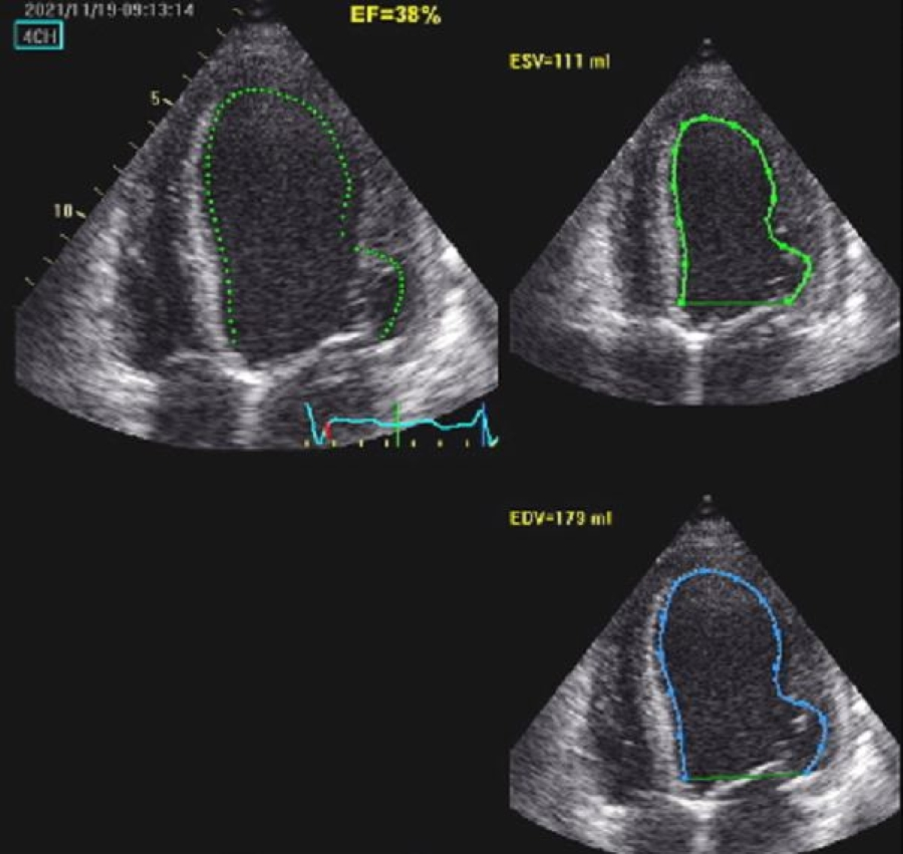 Cureus | Heart Failure Associated With Ventricular Septal Defect, Mitral  Valve Prolapse, Non-stenotic Bicuspid Aortic Valve, and Patent Foramen Ovale