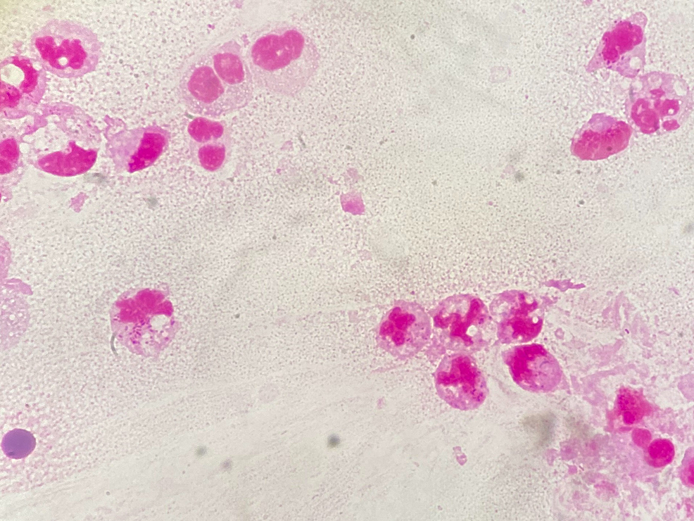 The-Gram-stain-of-the-sputum-showing-leukocytes-without-bacteria