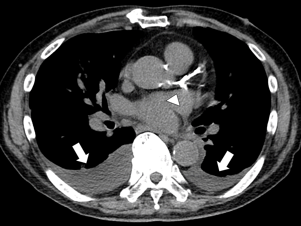 Chest-CT-showing-bilateral-pleural-effusions-(white-arrow)-and-calcification-of-coronary-arteries-(white-arrowhead)