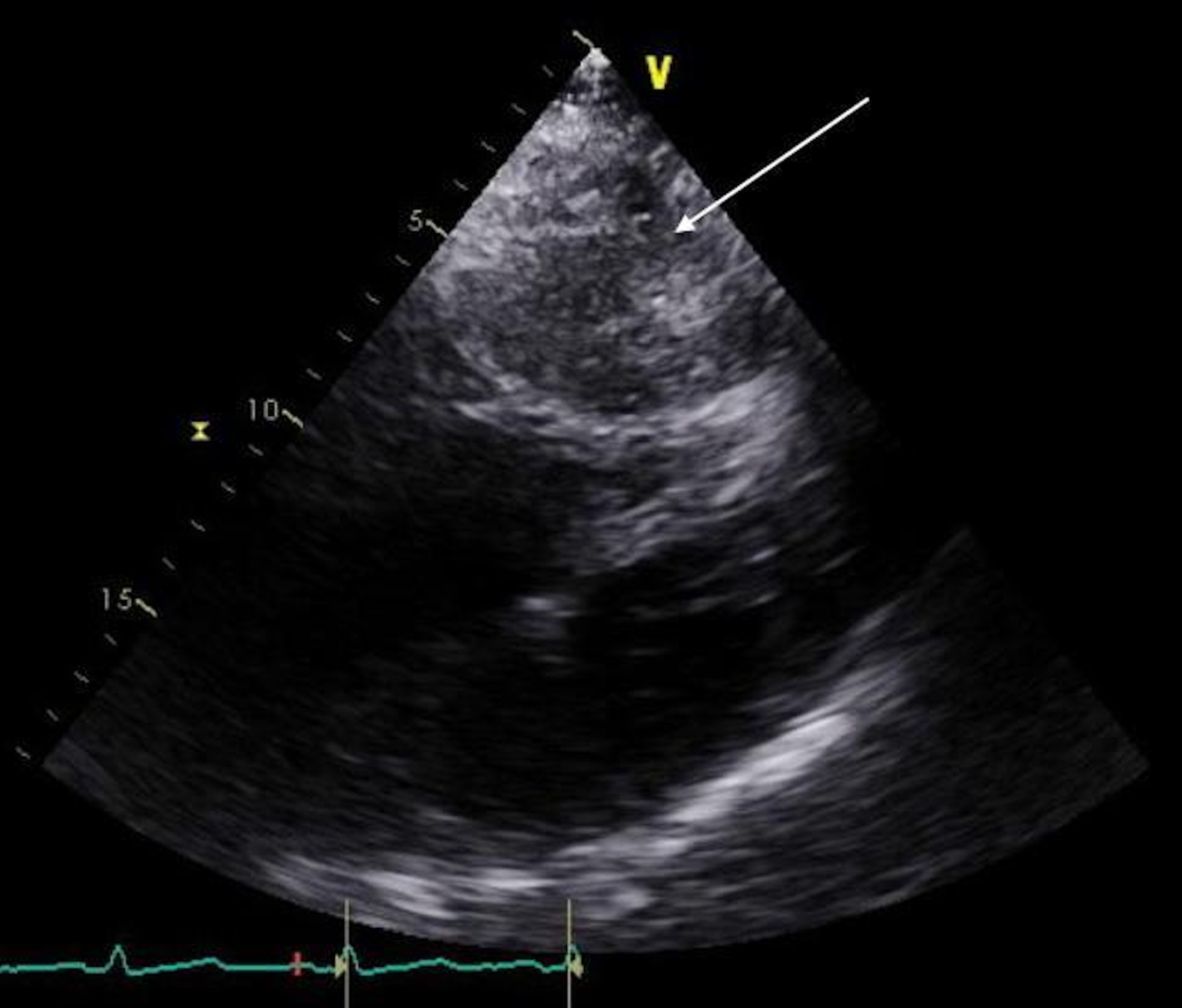 Cureus | A Breathtaking Hernia: A Giant Hiatal Hernia Masquerading as ...