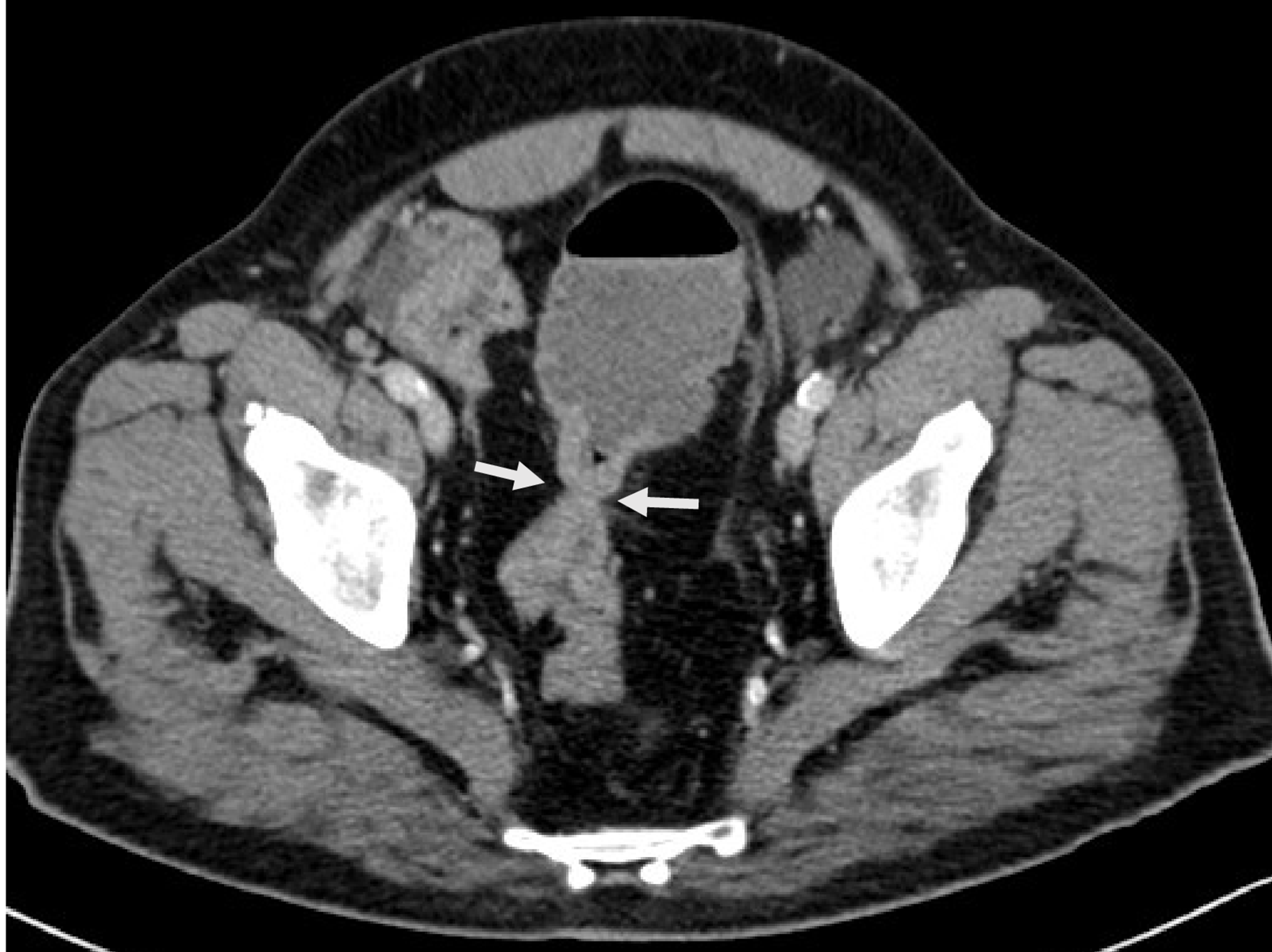 Cureus Successful Treatment of Synchronous Double Lung Primary Malignancies and Colon Cancer