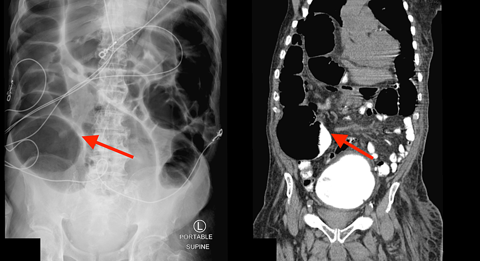 Cureus Chilaiditi's Sign Associated with Acute Colonic Pseudo