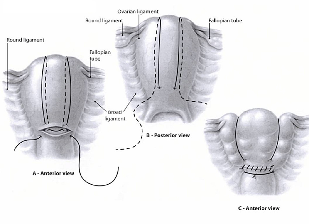 Towel Uterus Model For Uterine Compression Sutures Technical Skills ...