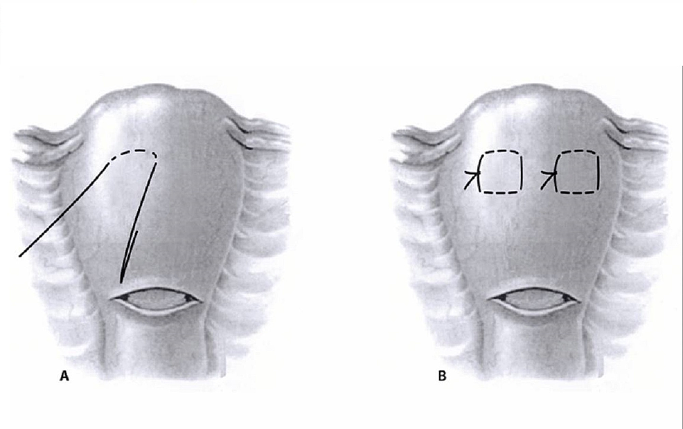 Cureus | Towel Uterus Model For Uterine Compression Sutures Technical ...