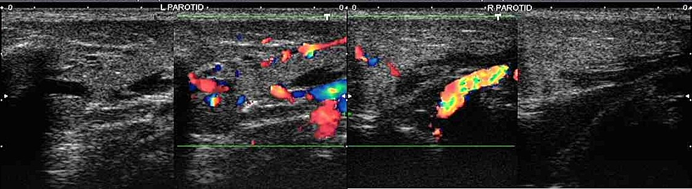 Ultrasound-greyscale-images-showing-diffuse-hypoechogenicity-and-enlargement-of-the-left-and-right-parotid-glands,-and-color-Doppler-images-demonstrating-increased-vascularity-(left>right)-within-parotid-glands-suggestive-of-acute-parotitis