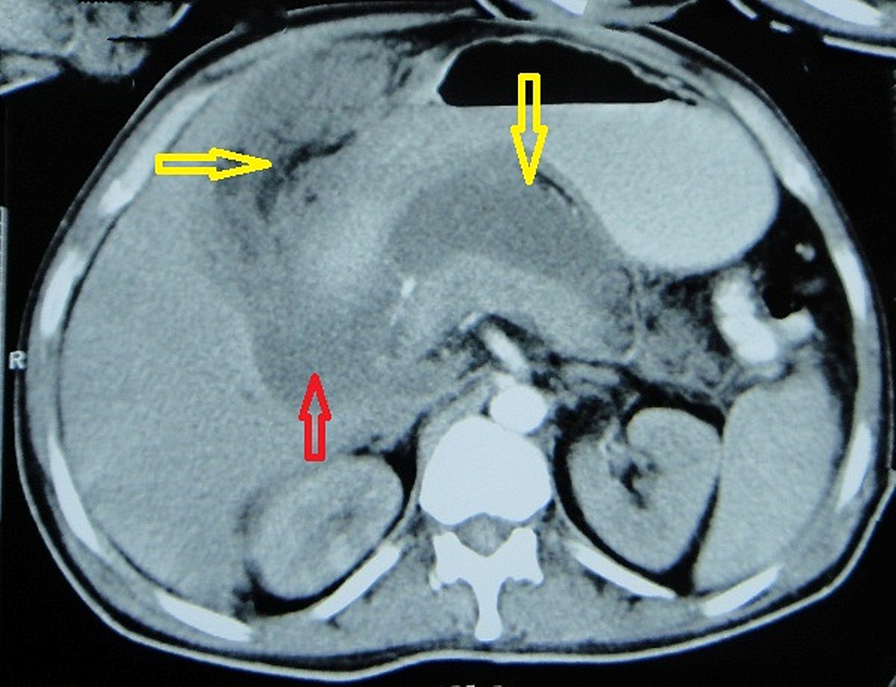 CECT-abdomen-axial-scan-at-the-level-of-the-pancreas:-There-is-mild-focal-hypodensity-in-the-head-and-hypodensity-in-the-tail-of-the-pancreas-suggestive-of-acute-pancreatitis.-There-is-fluid-collection-in-the-lesser-sac-(marked-by-vertical-yellow-arrow-containing-air-specks-on-the-non-dependent-part-[H.U.-value-around--302]),-uncinate-process-(marked-by-red-arrow),-and-right-subhepatic-space-marked-by-the-horizontal-yellow-arrow-(containing-fat-and-air-specks-within-[H.U.-value--50-to--290,-respectively]).