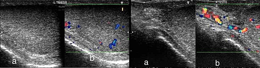 Ultrasound-Left-testis-(a)-Greyscale-image-showing-hypoechoic-echo-pattern-of-left-testis-and-(b)-Color-Doppler-demonstrating-increased-vascularity.-Ultrasound-Right-testis-(a)-Bulky-and-heterogeneously-hypoechoic-right-testis-and-epididymis-and-(b)-Color-Doppler-demonstrating-increased-vascularity-in-both-structures.-
