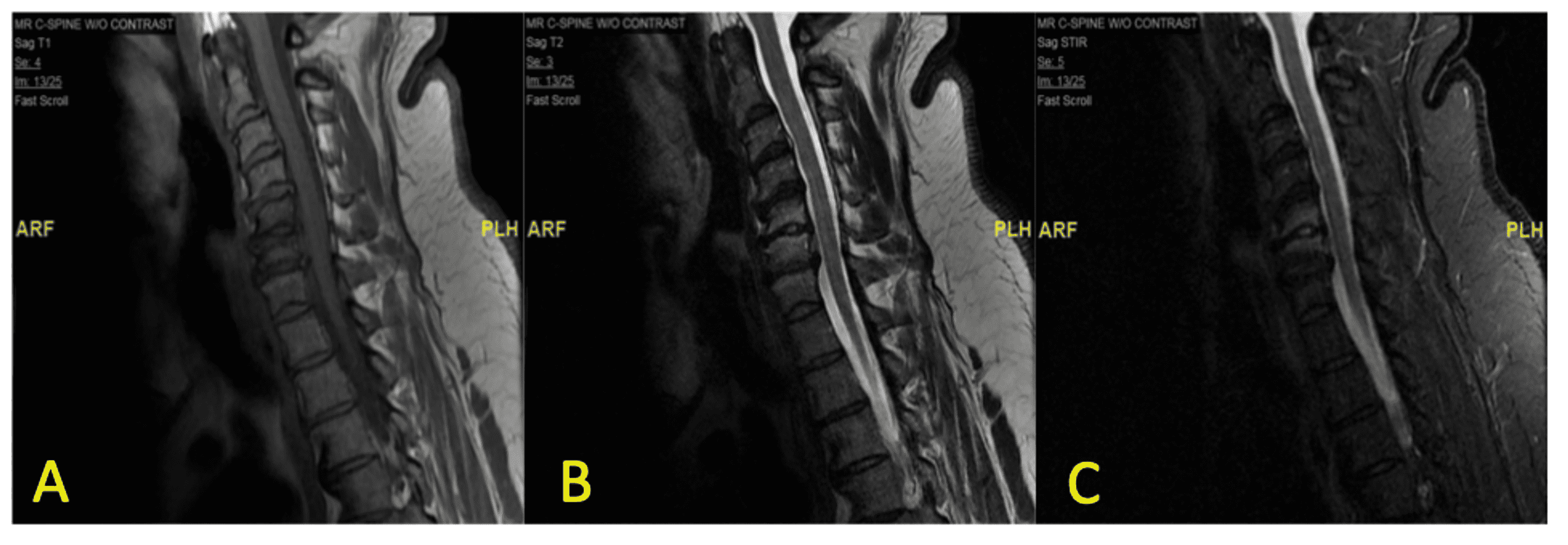 Cureus An Isolated Radiographic Finding of Spontaneous Vertebral