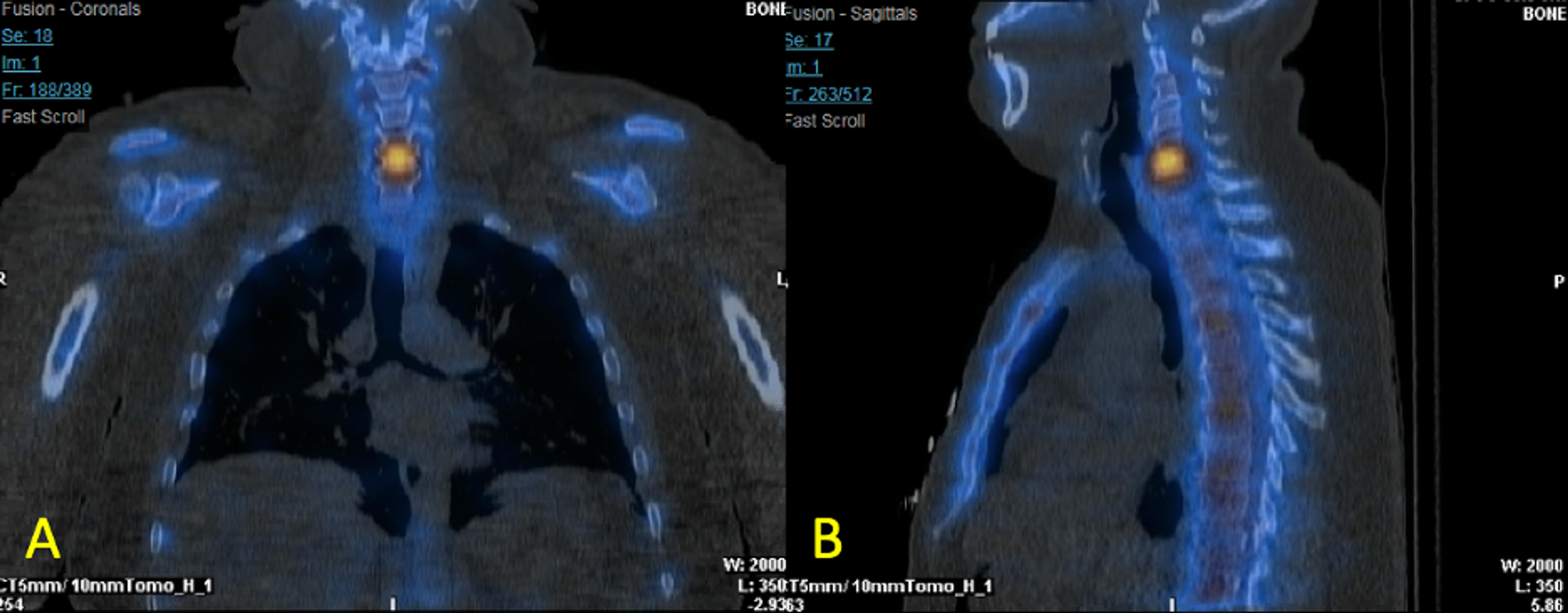 Cureus An Isolated Radiographic Finding of Spontaneous Vertebral
