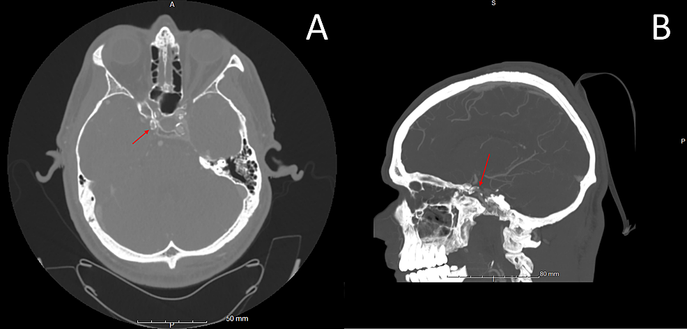 CT-angiogram-of-the-head,-axial-cut-(A)-and-sagittal-cut-(B)-demonstrating-atherosclerotic-changes-in-the-right-clinoid-ICA-(red-arrow)-resulting-in-approximately-70%-stenosis-per-WASID-criteria.-