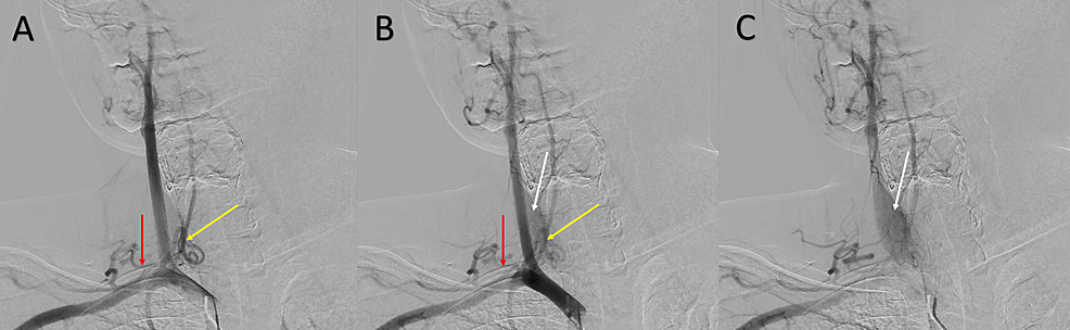 Brachiocephalic-artery-angiogram-progressing-from-A-to-C,-AP-view,-demonstrating-prominent-right-thyrocervical-trunk-(red-arrow),-right-inferior-thyroid-artery-(yellow-arrow)-and-thyroid-blush-(white-arrow).-