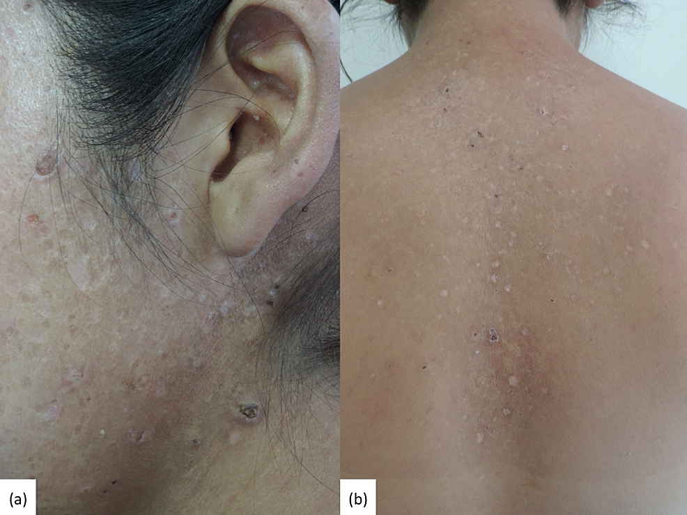 Cureus Acne Necrotica in a Woman With Systemic Lupus Erythematosus